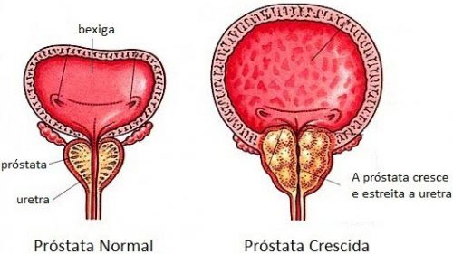 Prostata